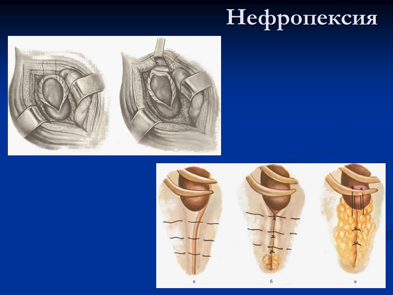 Нефропексия